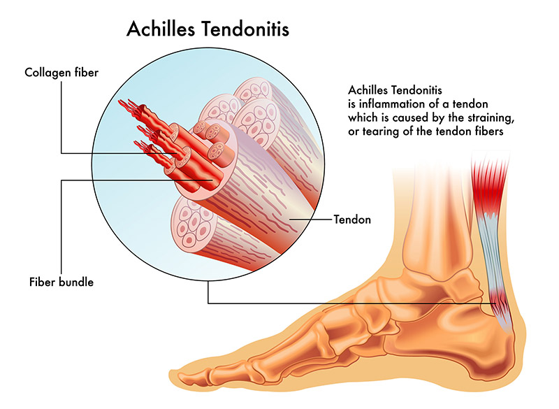 Achilles Tendonitis Diagram