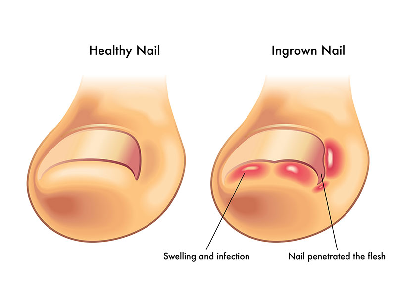 Ingrown Toenail Diagram