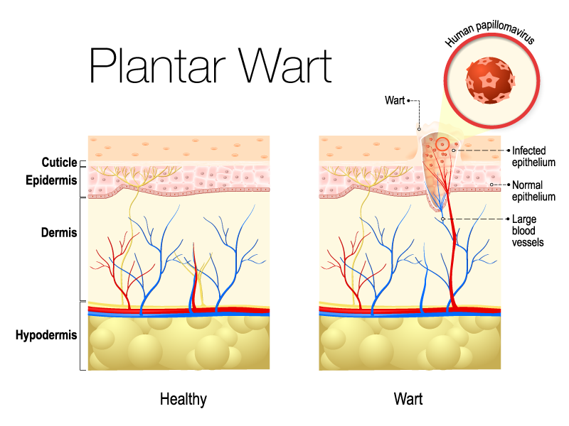 Plantar-Wart Plantar Wart Vector Illustration