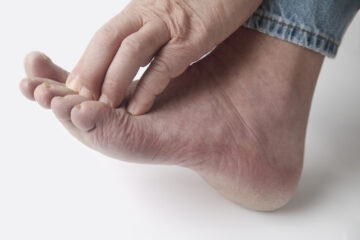 Athlete's Foot